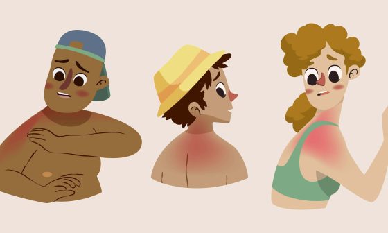 Cartoon illustration of people with sunburn